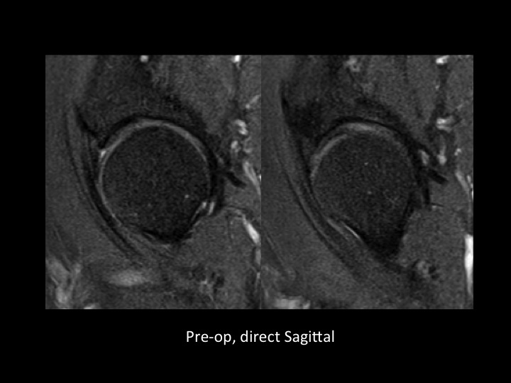 Figure 4 for case acetabular labrum ( RID2644 )